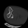 SPORK, NICO - 22.03.1976 - 02.08.2022 - CT obere Extremität - 17:51:17